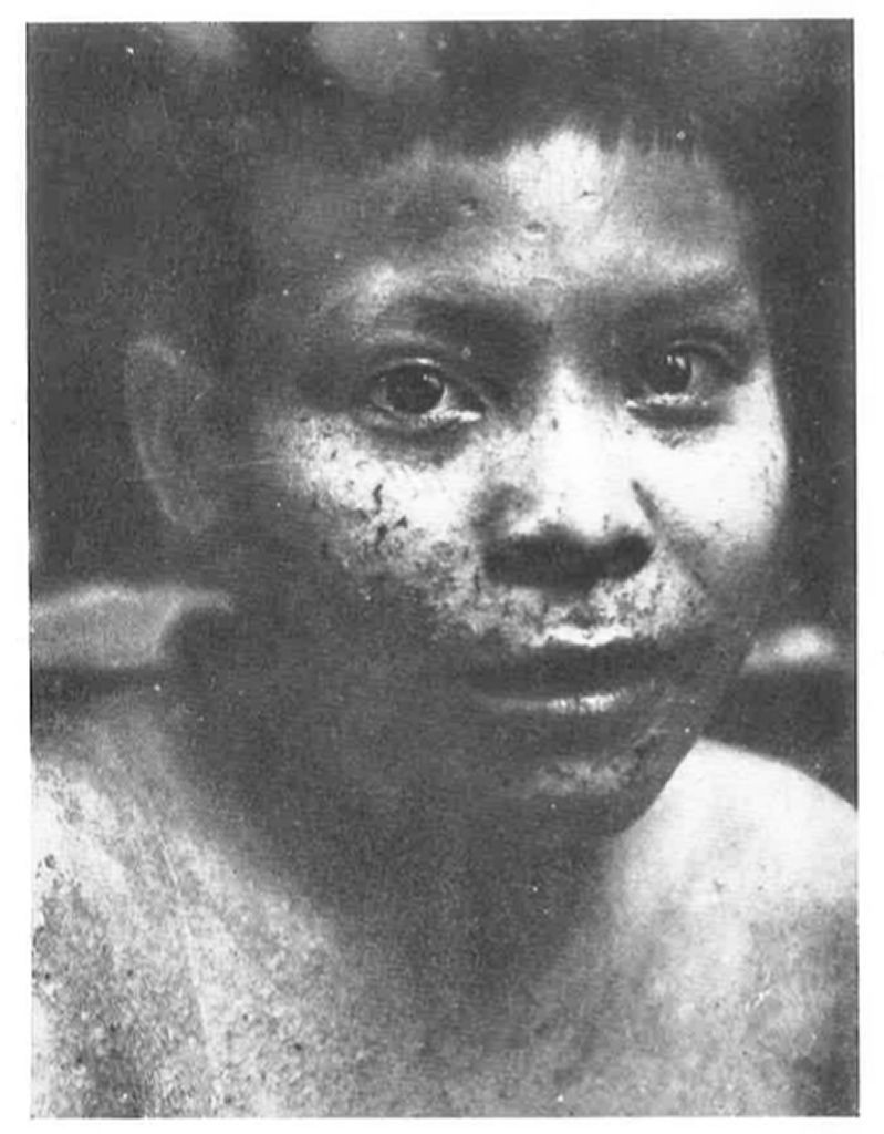 Foto de un niño Puruborá con la enfermedad de la piel conocida como 