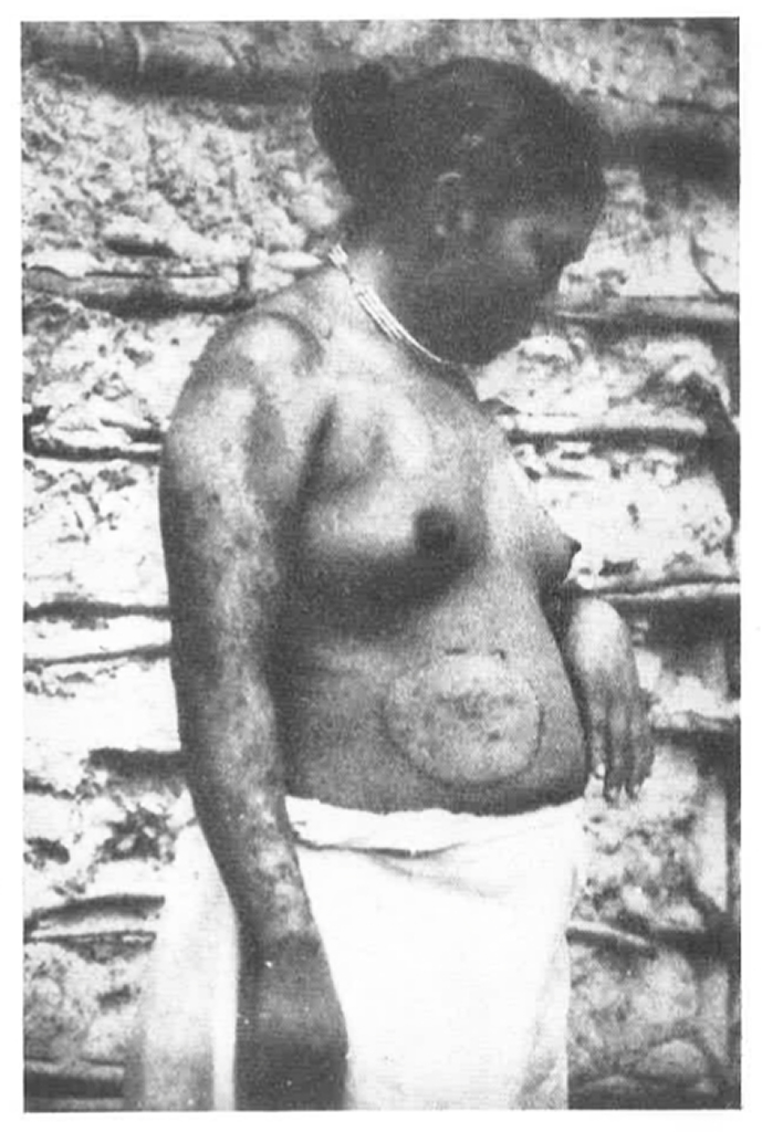 Foto de uma mulher Puruborá portadora da doença de pele conhecida como “chimbêrê”. Fotografia de Olympio da Fonseca Filho, obtida no alto rio São Miguel em 1924. Tratam-se das primeiras imagens dos Puruborá, alguns anos após o contato.